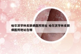 哈尔滨学林皮肤病医院地址 哈尔滨学林皮肤病医院地址在哪