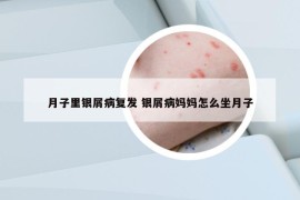 月子里银屑病复发 银屑病妈妈怎么坐月子