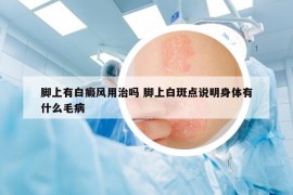 脚上有白癜风用治吗 脚上白斑点说明身体有什么毛病