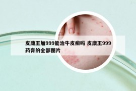 皮康王加999能治牛皮癣吗 皮康王999药膏的全部图片