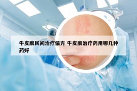 牛皮廨民间治疗偏方 牛皮廨治疗药用哪几种药好