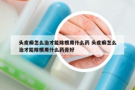 头皮癣怎么治才能除根用什么药 头皮癣怎么治才能除根用什么药膏好