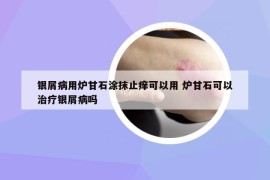 银屑病用炉甘石涂抹止痒可以用 炉甘石可以治疗银屑病吗