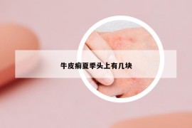 牛皮癣夏季头上有几块