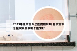 2023年北京空军总医院银屑病 北京空军总医院银屑病哪个医生好