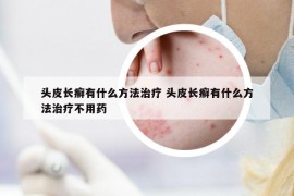 头皮长癣有什么方法治疗 头皮长癣有什么方法治疗不用药