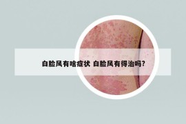 白脸风有啥症状 白脸风有得治吗?