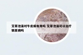 艾草泡澡对牛皮癣有用吗 艾草泡澡可以治疗银屑病吗