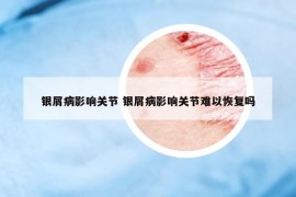 银屑病影响关节 银屑病影响关节难以恢复吗