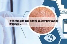 青黛对银屑病消斑有用吗 青黛对银屑病消斑有用吗图片