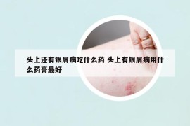 头上还有银屑病吃什么药 头上有银屑病用什么药膏最好