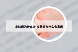 皮肤癣为什么会 皮肤癣为什么会发痒