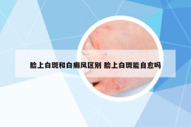 脸上白斑和白癜风区别 脸上白斑能自愈吗