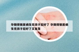 孕期得银屑病生完孩子后好了 孕期得银屑病生完孩子后好了又复发