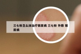 三七粉怎么抹治疗银屑病 三七粉 外敷 银屑病