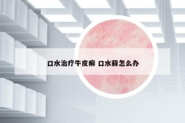 口水治疗牛皮癣 口水藓怎么办