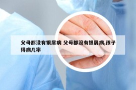 父母都没有银屑病 父母都没有银屑病,孩子得病几率