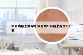 银屑病腿上没有吗 银屑病只有腿上有也不扩散