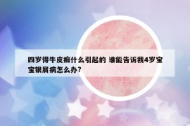 四岁得牛皮癣什么引起的 谁能告诉我4岁宝宝银屑病怎么办?