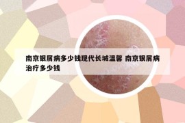 南京银屑病多少钱现代长城温馨 南京银屑病治疗多少钱