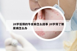 20岁后得的牛皮癣怎么回事 20岁得了银屑病怎么办