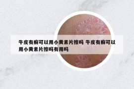 牛皮有癣可以用小黄素片擦吗 牛皮有癣可以用小黄素片擦吗有用吗