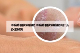 荨麻疹图片和症状 荨麻疹图片和症状有什么办法解决