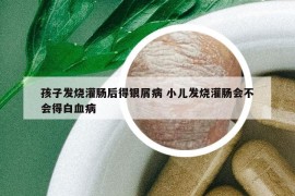 孩子发烧灌肠后得银屑病 小儿发烧灌肠会不会得白血病