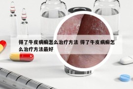 得了牛皮病癣怎么治疗方法 得了牛皮病癣怎么治疗方法最好