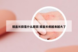 膝盖长藓是什么原因 膝盖长癣越来越大了