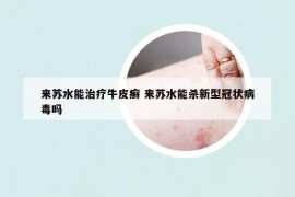 来苏水能治疗牛皮癣 来苏水能杀新型冠状病毒吗