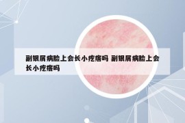 副银屑病脸上会长小疙瘩吗 副银屑病脸上会长小疙瘩吗