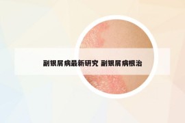 副银屑病最新研究 副银屑病根治