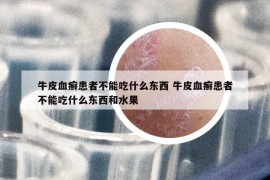 牛皮血癣患者不能吃什么东西 牛皮血癣患者不能吃什么东西和水果