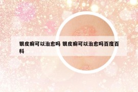 银皮癣可以治愈吗 银皮癣可以治愈吗百度百科