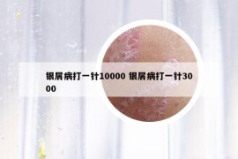 银屑病打一针10000 银屑病打一针3000