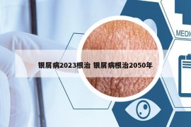 银屑病2023根治 银屑病根治2050年