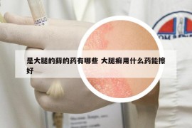 是大腿的藓的药有哪些 大腿癣用什么药能擦好