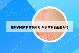 银屑病跟脾胃有关系吗 银屑病会引起脾大吗