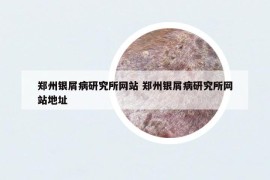 郑州银屑病研究所网站 郑州银屑病研究所网站地址