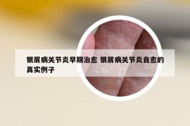 银屑病关节炎早期治愈 银屑病关节炎自愈的真实例子