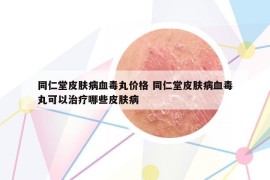 同仁堂皮肤病血毒丸价格 同仁堂皮肤病血毒丸可以治疗哪些皮肤病