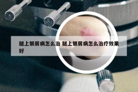 腿上银屑病怎么治 腿上银屑病怎么治疗效果好