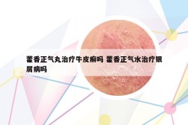 藿香正气丸治疗牛皮癣吗 藿香正气水治疗银屑病吗