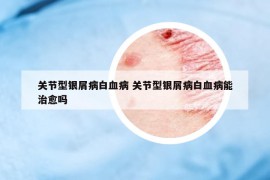 关节型银屑病白血病 关节型银屑病白血病能治愈吗