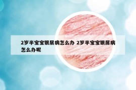 2岁半宝宝银屑病怎么办 2岁半宝宝银屑病怎么办呢