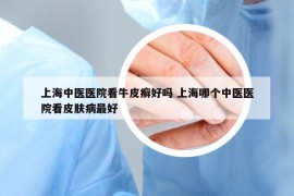 上海中医医院看牛皮癣好吗 上海哪个中医医院看皮肤病最好