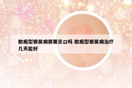 脓疱型银屑病需要忌口吗 脓疱型银屑病治疗几天能好