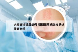 ct能确诊银屑病吗 初期银屑病做皮肤ct能确定吗