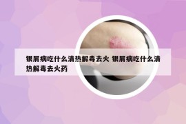 银屑病吃什么清热解毒去火 银屑病吃什么清热解毒去火药